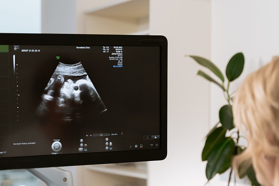 Ultrasound monitor showing a prenatal scan